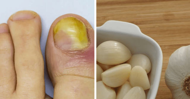 Agua tibia y ajo para los hongos en las uñas