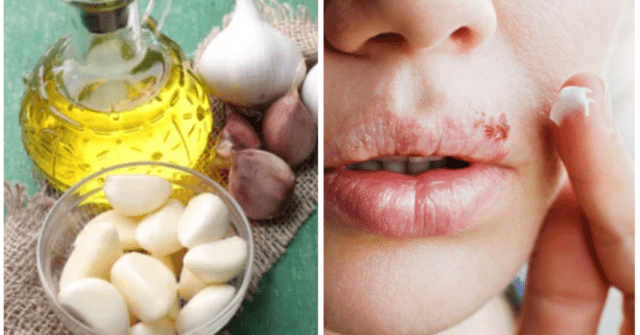 Dientes de ajo y aceite vegetal para el herpes