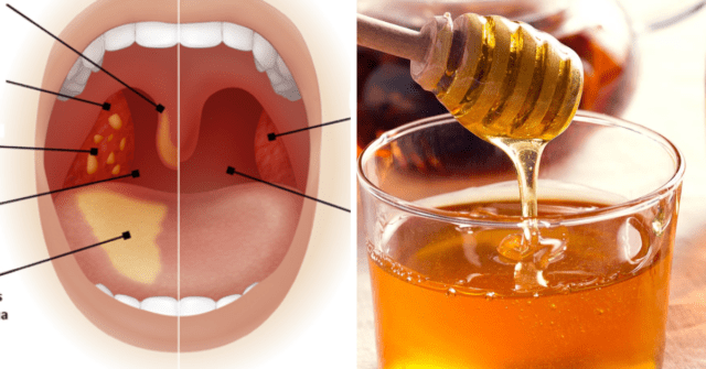 Limón y miel de abeja para la garganta
