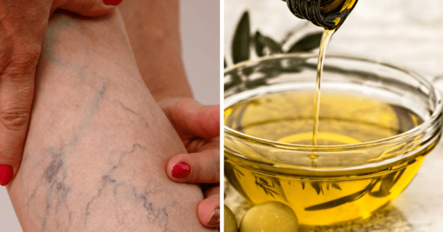 Aceite de oliva y hojas de laurel contra las varices