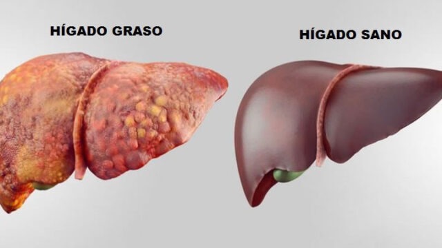 SEÑALES DE UN HÍGADO GRASO