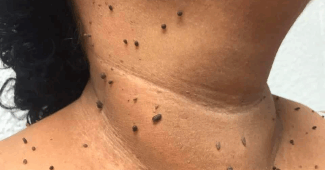 ¿QUÉ SON LOS FIBROPAPILOMAS Y POR QUÉ APARECEN EN LA PIEL?