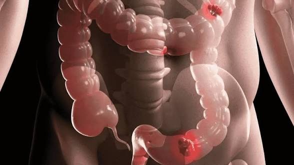 Señales tempranas de cáncer de colon que pueden ayudarte a detectarlo a tiempo